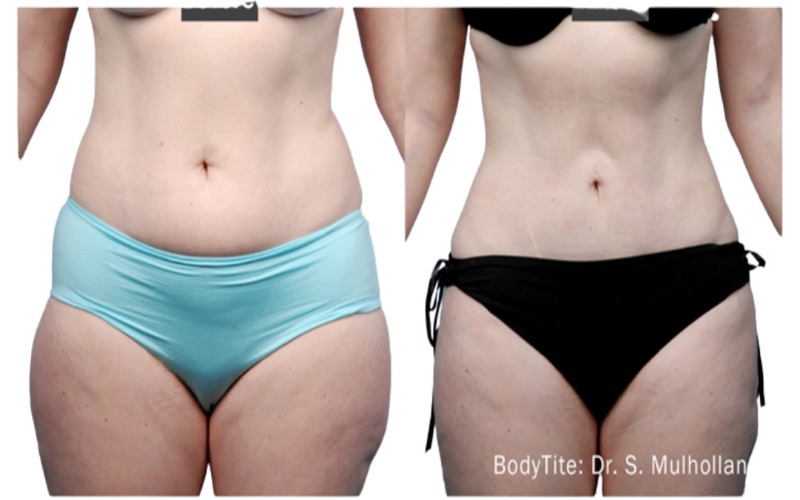 Radiofrequency For Cellulite & Fat Information